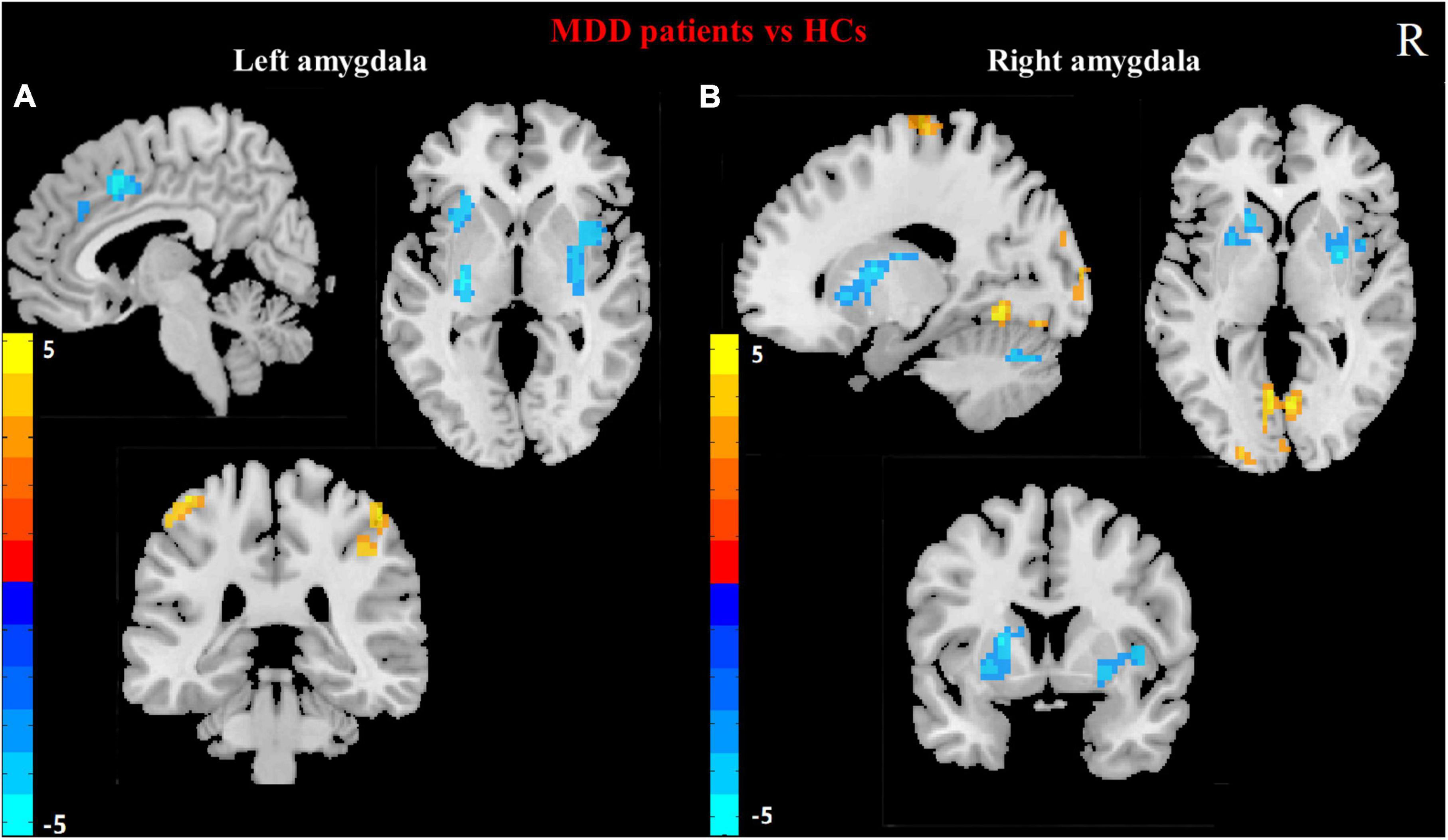 Functional connectivity of the amygdala and the antidepressant and antisuicidal effects of repeated ketamine infusions in major depressive disorder